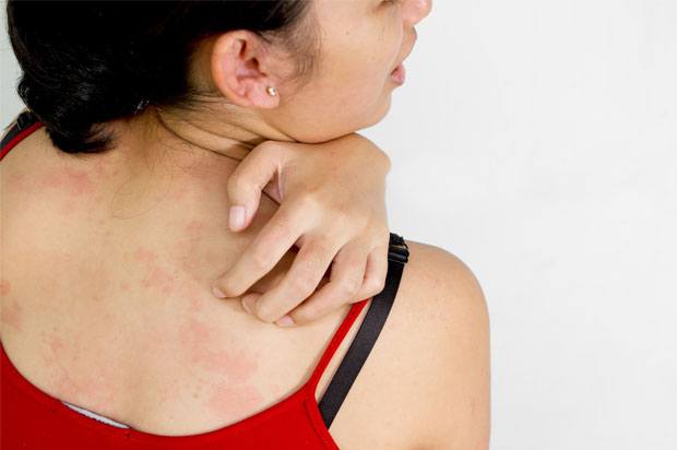 Woman with eczema on her back scratching it